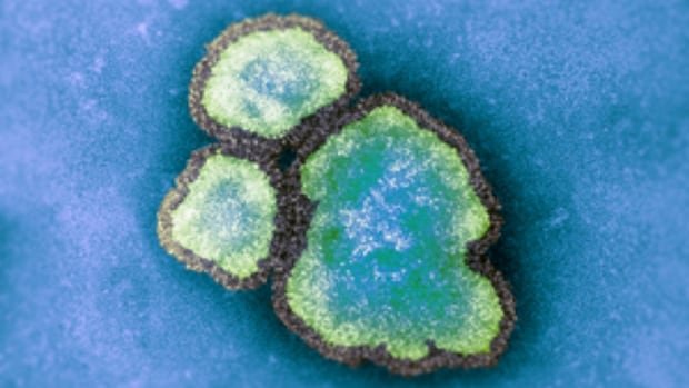 Quebec Health Ministry reports new measles cases Quebec Health Ministry reports new measles cases