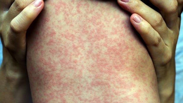 Measles ‘out of control,’ experts warn, as Alberta case counts surpass 1,000 Measles ‘out of control,’ experts warn, as Alberta case counts surpass 1,000